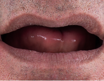 Before all-on dental implants