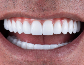 After all-on dental implants