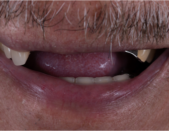 Before multiple dental implants
