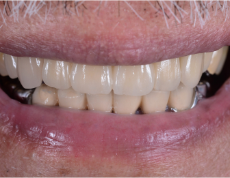 After multiple dental implants