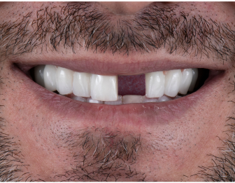Before single tooth implant