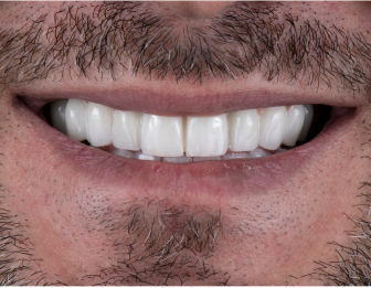After single tooth implant